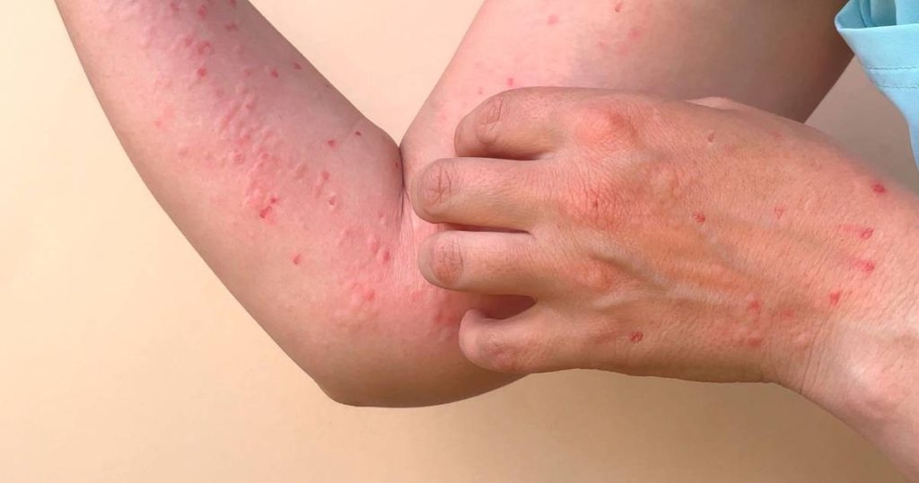 Viruela del mono - El financiero